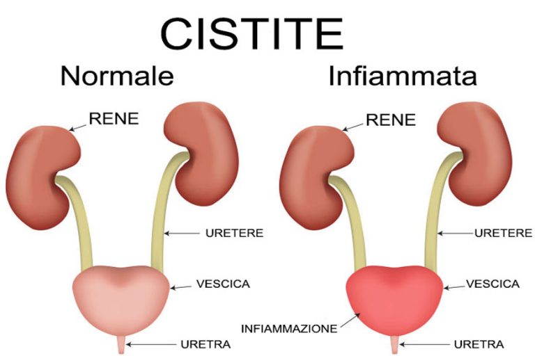 Si Puo Fare Sesso Con La Cistite La Cistite: sintomi, cause, cura e rimedi naturali - Salute Online